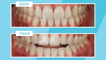 Before-after Spark Clear Aligners