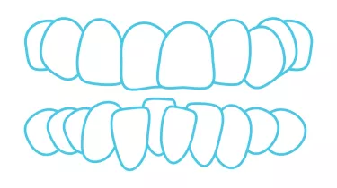 Spark Aligners for crowding 