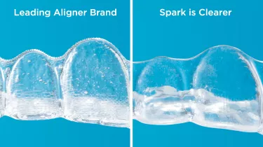 Spark Aligners is more clear