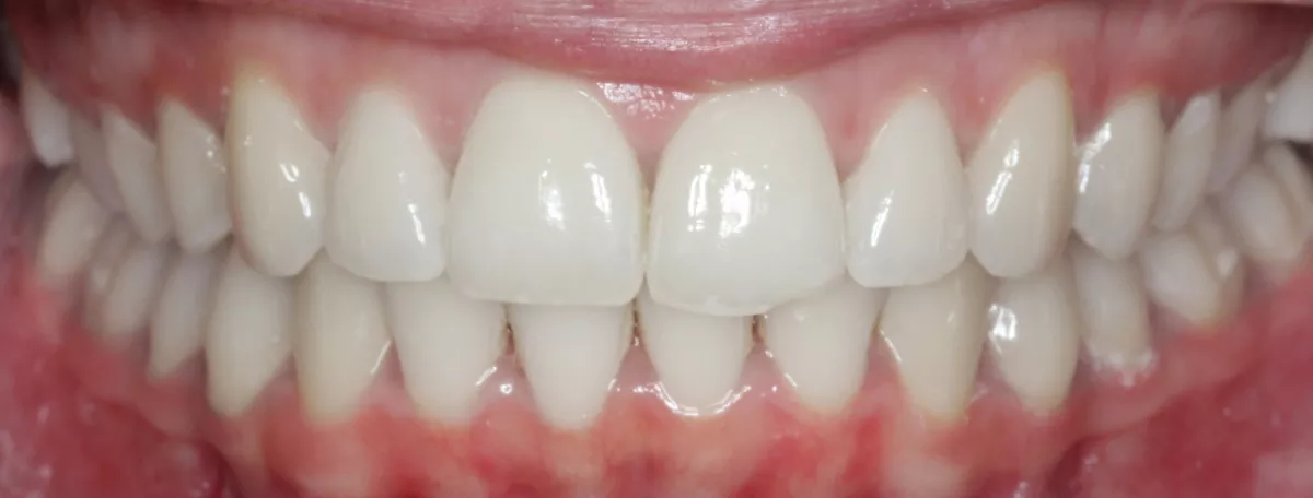 Can clear aligners fix an overbite? - SmilePath NZ