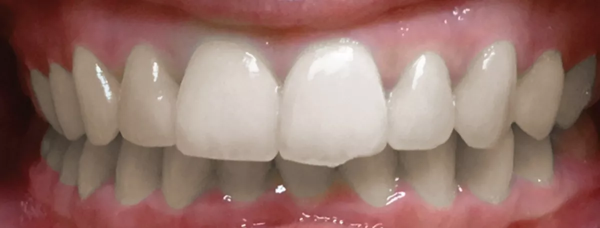 Overbite Correction with Clear Aligners in Thousand Oaks