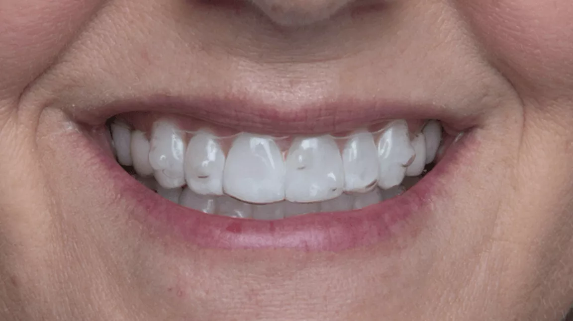 https://sparkaligners.com/sites/g/files/wdvifx211/files/styles/optimized/public/2022-07/patient-with-clear-aligners.jpg.webp?itok=-defCqI0