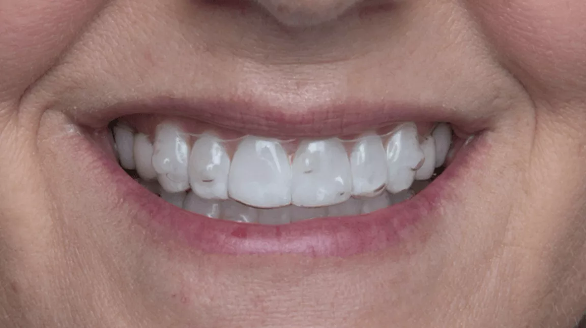 Everything You Need To Know About Attachments With Clear Aligners