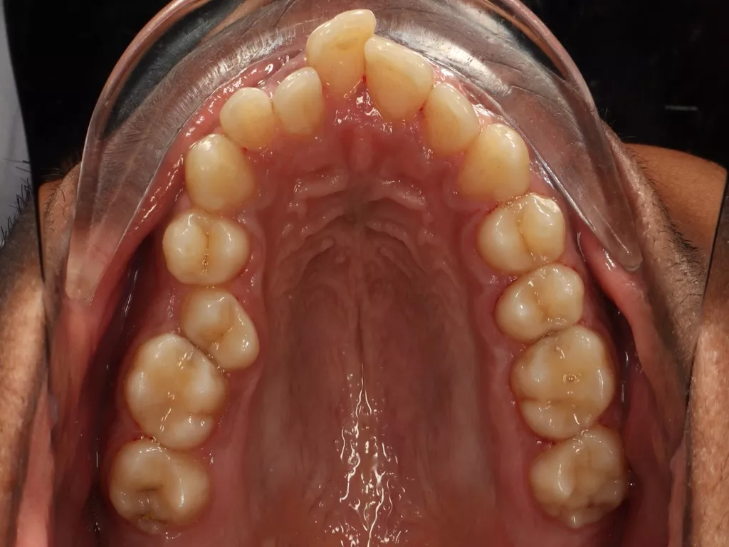 Case 2_Upper