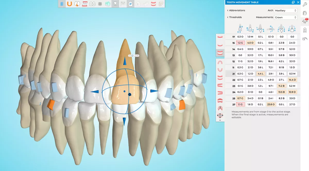 Clear Aligners vs Braces