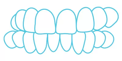 Spark Aligners teeth crossbite