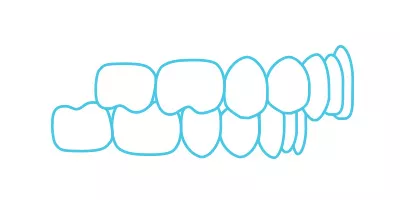 Spark Aligners teeth overbite