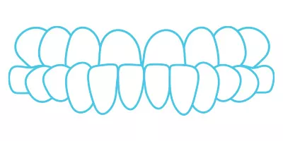 Spark Aligners teeth uderbite